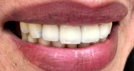 Smile with discoloration corrected